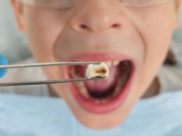 Best Emergency Dentist for Lost Fillings or Crowns in Mcadoo, PA